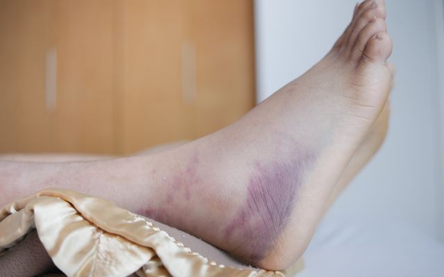 Charcot Ayak ve Diyabet