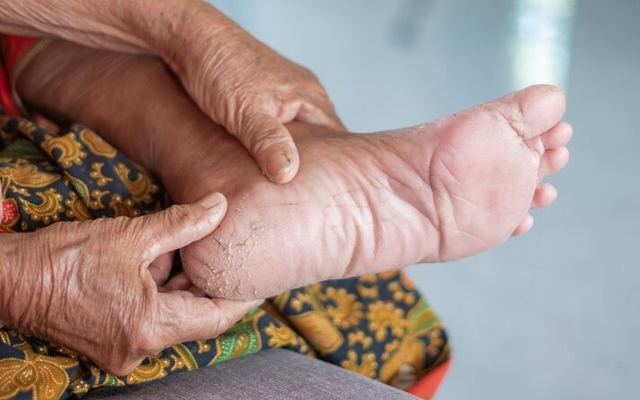 Diyabetik Ayak Enfeksiyonları: Nedenleri, Belirtileri ve Tedavi Yöntemleri