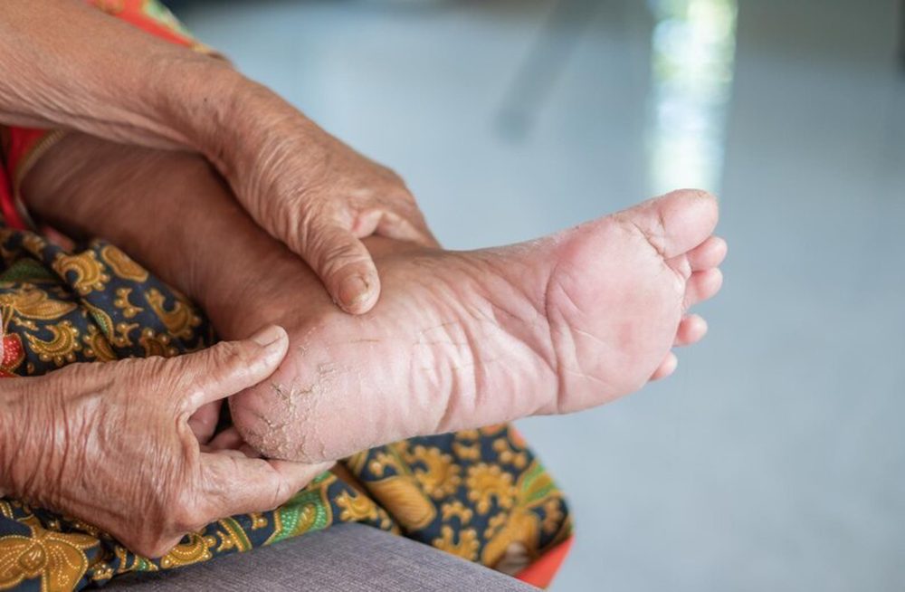 Diyabetik Ayak Enfeksiyonları: Nedenleri, Belirtileri ve Tedavi Yöntemleri