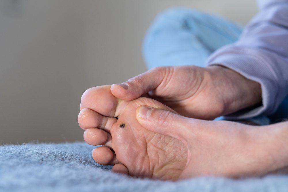 Diabetic Foot Treatment: The Importance of Early Diagnosis and Proper Approach