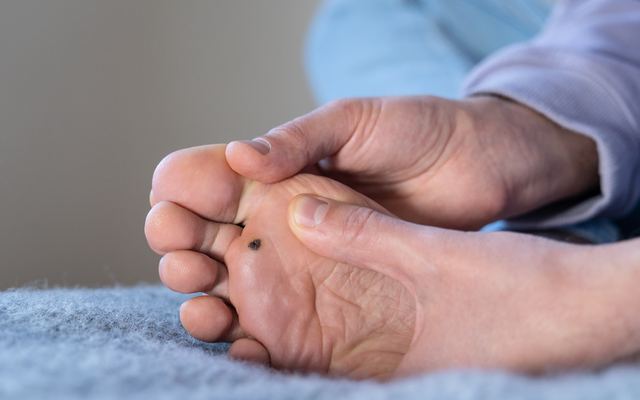 Diabetic Foot Treatment: The Importance of Early Diagnosis and Proper Approach