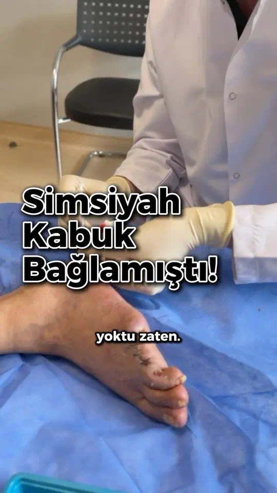 Simsiyah Kabuk Bağlamıştı! #DiyabetikAyak